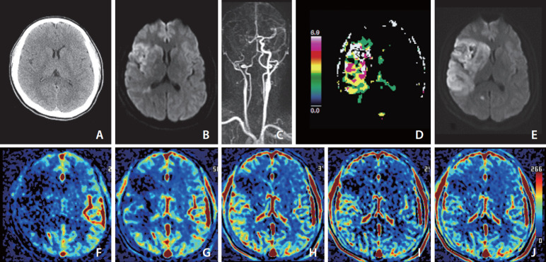 Imaging in Acute Anterior Circulation Ischemic Stroke: Current and Future.