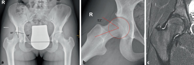 [Femoroacetabular impingement syndrome in adolescents-How to adivse? How to treat?]