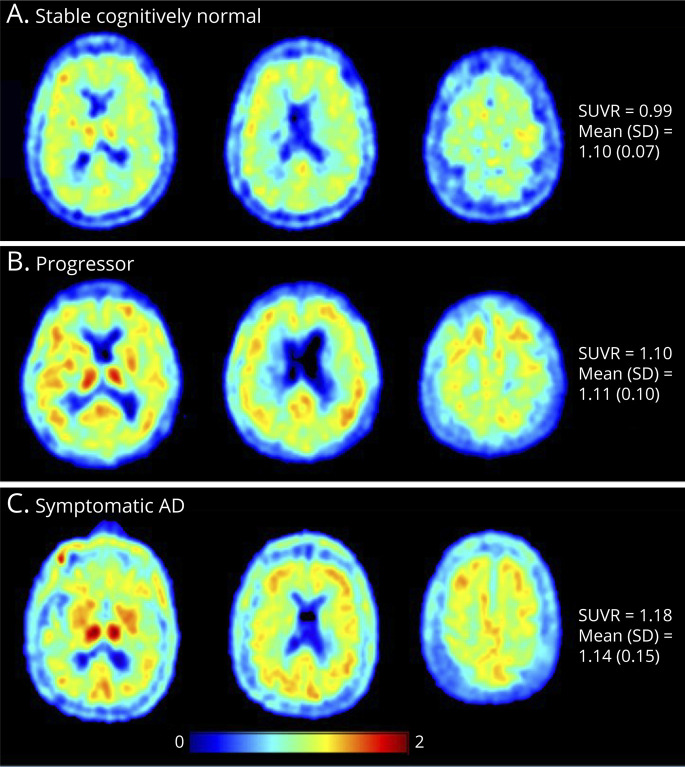 Baseline Microglial Activation Correlates With Brain Amyloidosis and Longitudinal Cognitive Decline in Alzheimer Disease.