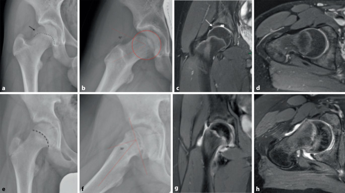 [Femoroacetabular impingement syndrome in adolescents-How to adivse? How to treat?]