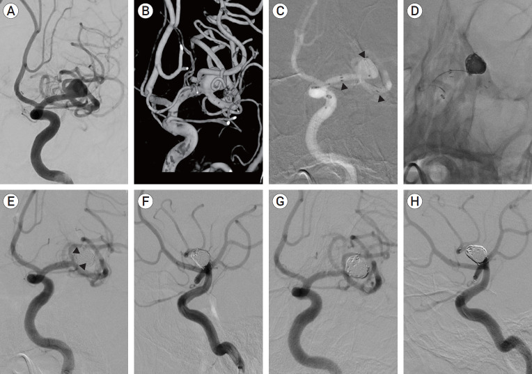 Y-stent-assisted coiling with Neuroform Atlas stents for wide-necked intracranial bifurcation aneurysms: A preliminary report.