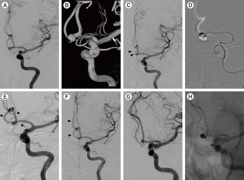 Y-stent-assisted coiling with Neuroform Atlas stents for wide-necked intracranial bifurcation aneurysms: A preliminary report.