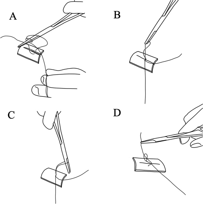 Influence of a novel suturing technique on periodontal health of mandibular second molar following impacted third molar surgery: a split-mouth randomized clinical trial.