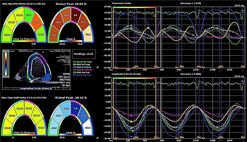 Assessment of functional and structural echocardiography parameters in patients with frequent premature ventricular contractions without structural heart disease.