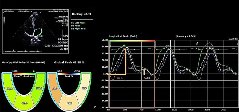 Assessment of functional and structural echocardiography parameters in patients with frequent premature ventricular contractions without structural heart disease.