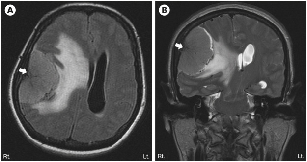 Transient Anarthria in a Patient With Non-Dominant Hemispheric Lesion: A Case Report.