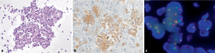 [The value of molecular testing of thyroid aspirates].