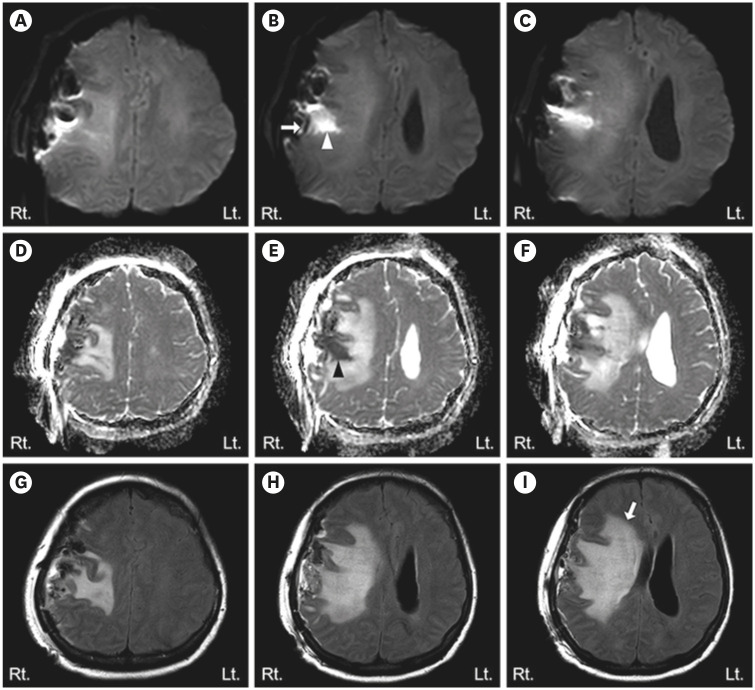 Transient Anarthria in a Patient With Non-Dominant Hemispheric Lesion: A Case Report.