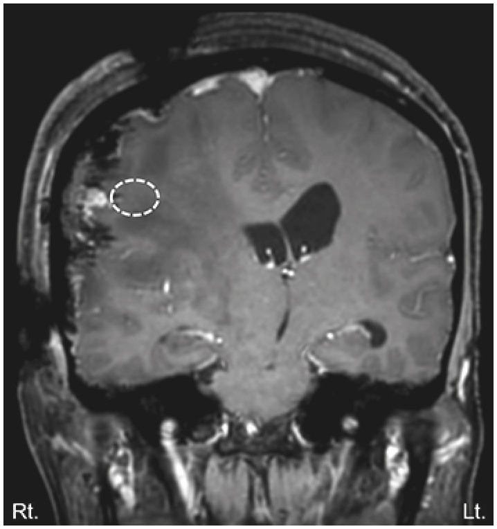 Transient Anarthria in a Patient With Non-Dominant Hemispheric Lesion: A Case Report.