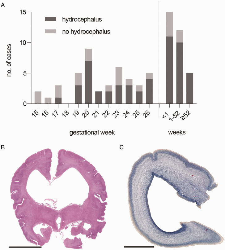 Cerebral Abnormalities in Spina Bifida: A Neuropathological Study.