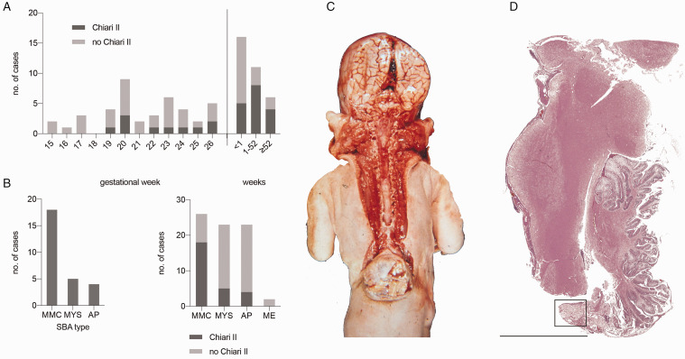 Cerebral Abnormalities in Spina Bifida: A Neuropathological Study.
