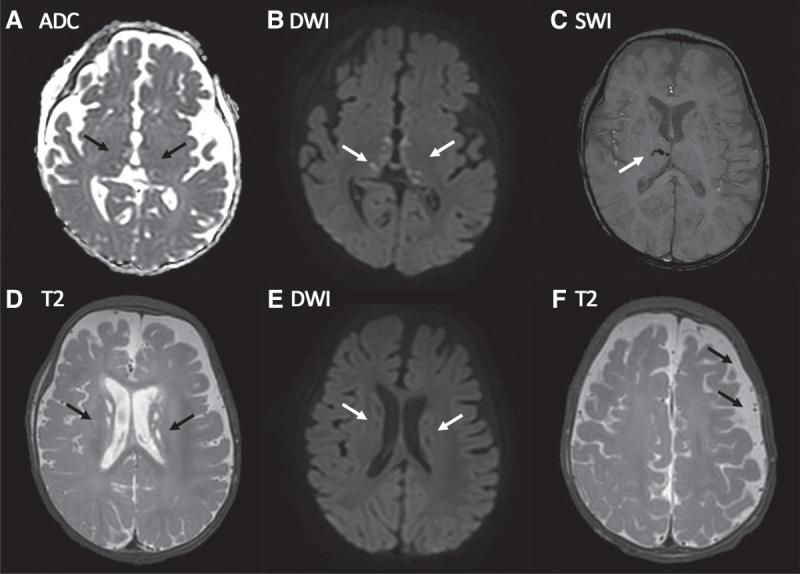 Ethylmalonic encephalopathy masquerading as meningococcemia.