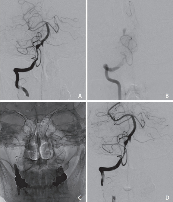 Usefulness of Self-Expandable Stent for Recanalization of Intracranial Atherosclerotic Disease: Preliminary Experience with Enterprise Stent.