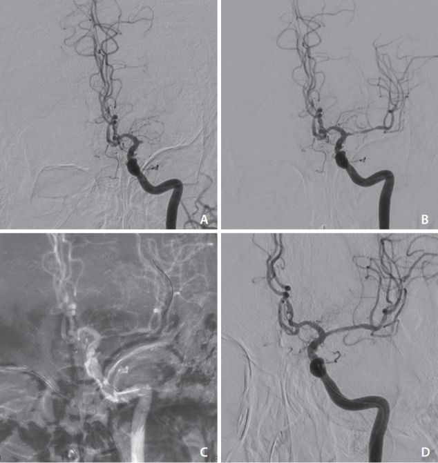 Usefulness of Self-Expandable Stent for Recanalization of Intracranial Atherosclerotic Disease: Preliminary Experience with Enterprise Stent.