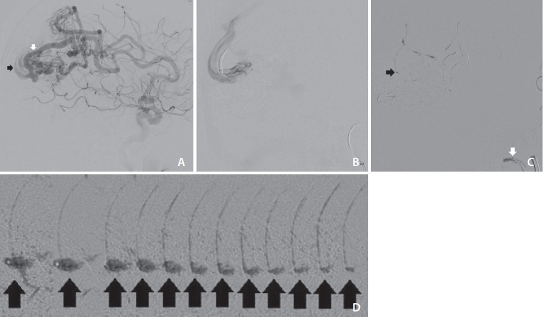 Snowballing Technique for High Flow Arteriovenous Fistula: A Technical Note.