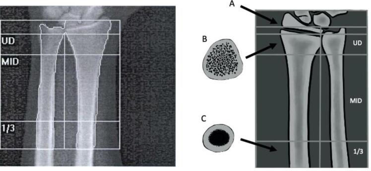 An update on methods for assessing bone quality and health in Cystic fibrosis