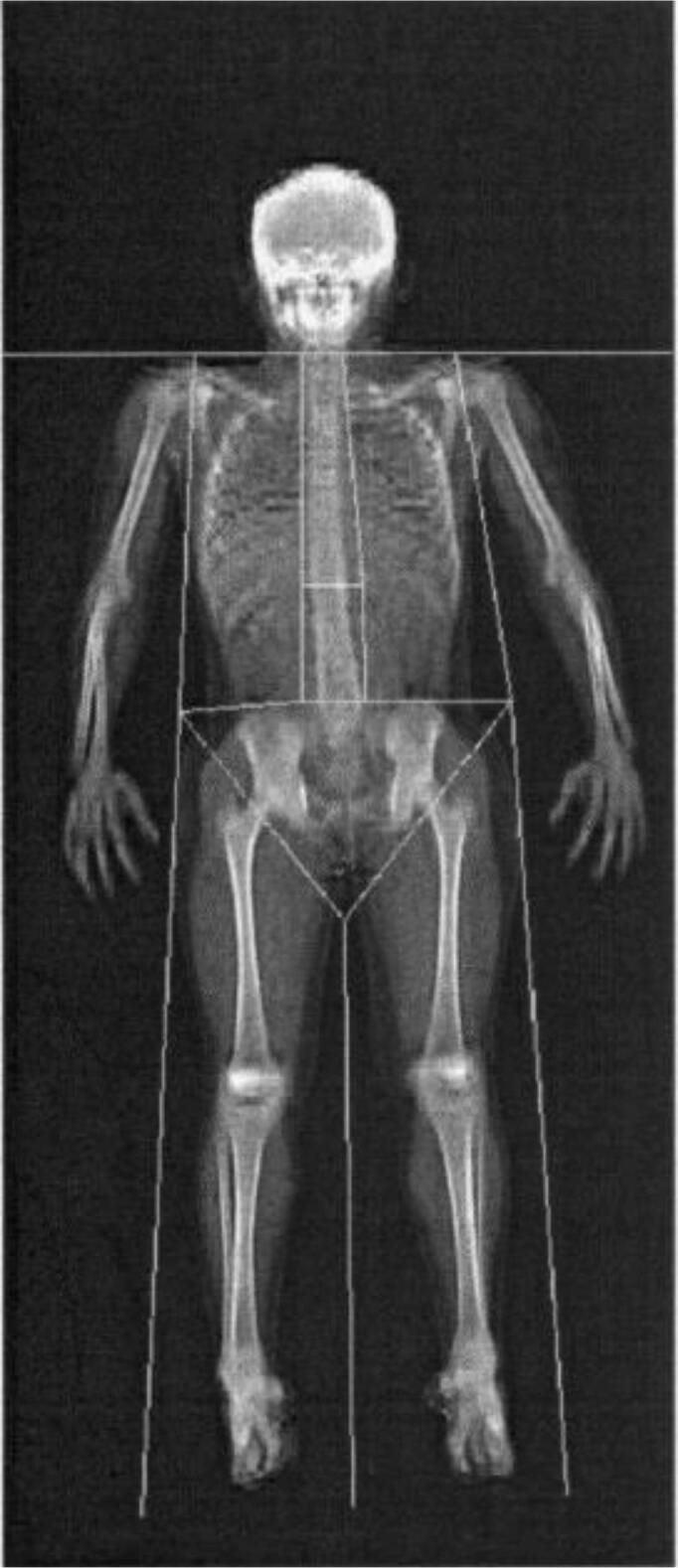 An update on methods for assessing bone quality and health in Cystic fibrosis