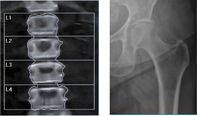 An update on methods for assessing bone quality and health in Cystic fibrosis