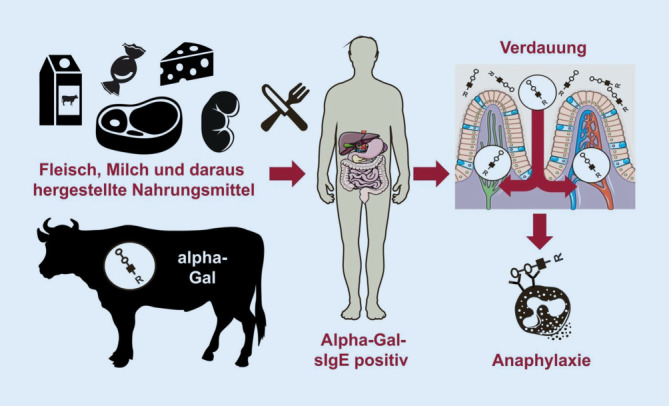 [Alpha-gal syndrome : Overview of clinical presentation and pathophysiology].