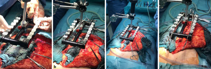 [Intraoperative fascial traction (IFT) for treatment of large ventral hernias : A retrospective analysis of 50 cases].