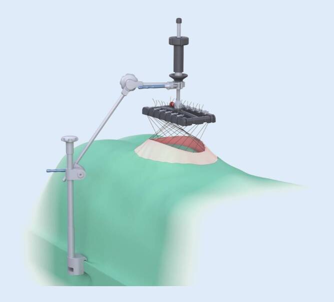 [Intraoperative fascial traction (IFT) for treatment of large ventral hernias : A retrospective analysis of 50 cases].