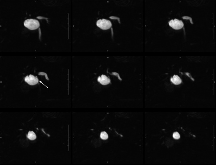 The diagnostic value of hepatobiliary scintigraphy for choledochal cysts in the era of magnetic resonance imaging with cholangiopancreatography and contrast-enhanced hepatobiliary phase: a case report and review.