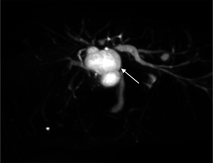 The diagnostic value of hepatobiliary scintigraphy for choledochal cysts in the era of magnetic resonance imaging with cholangiopancreatography and contrast-enhanced hepatobiliary phase: a case report and review.