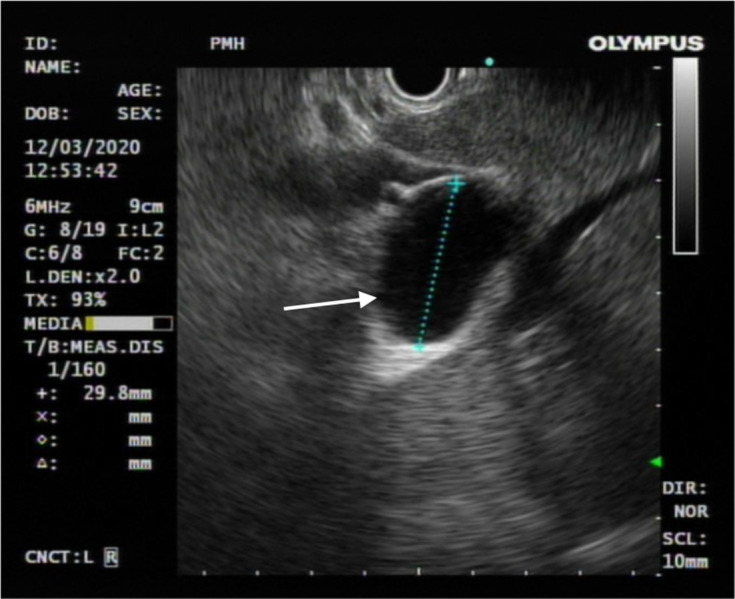 The diagnostic value of hepatobiliary scintigraphy for choledochal cysts in the era of magnetic resonance imaging with cholangiopancreatography and contrast-enhanced hepatobiliary phase: a case report and review.