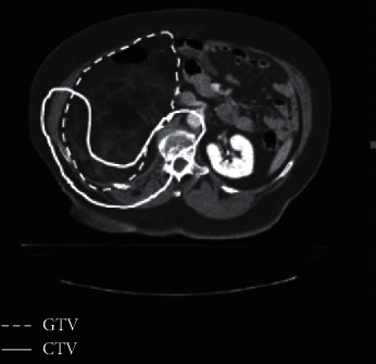 Comparison of 3D Conformal Proton Therapy, Intensity-Modulated Proton Therapy, and Intensity-Modulated Photon Therapy for Retroperitoneal Sarcoma.