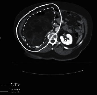 Comparison of 3D Conformal Proton Therapy, Intensity-Modulated Proton Therapy, and Intensity-Modulated Photon Therapy for Retroperitoneal Sarcoma.