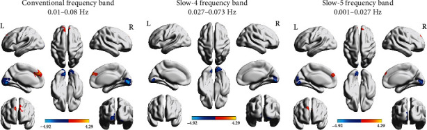 Functional Connectivity Changes in Multiple-Frequency Bands in Acute Basal Ganglia Ischemic Stroke Patients: A Machine Learning Approach.