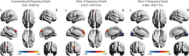 Functional Connectivity Changes in Multiple-Frequency Bands in Acute Basal Ganglia Ischemic Stroke Patients: A Machine Learning Approach.
