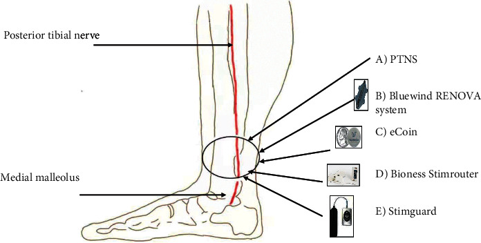 Posterior Tibial Nerve Stimulation for Overactive Bladder: Mechanism, Classification, and Management Outlines.