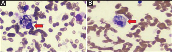 Inactivated COVID-19 vaccine triggering hemophagocytic lymphohistiocytosis in an immunocompetent adult - A case report.