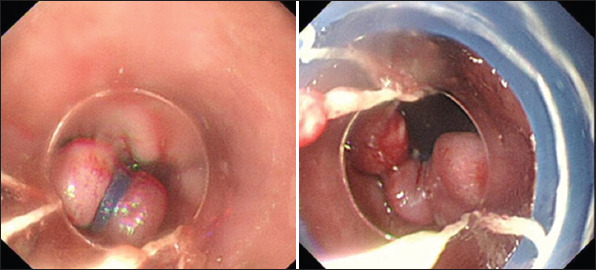 Endoscopic tightening of the cardia mucosa in gastroesophageal reflux disease: A case series of 120 patients up to 1-year follow-up.
