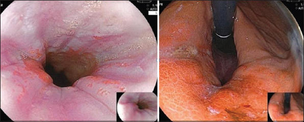 Endoscopic tightening of the cardia mucosa in gastroesophageal reflux disease: A case series of 120 patients up to 1-year follow-up.