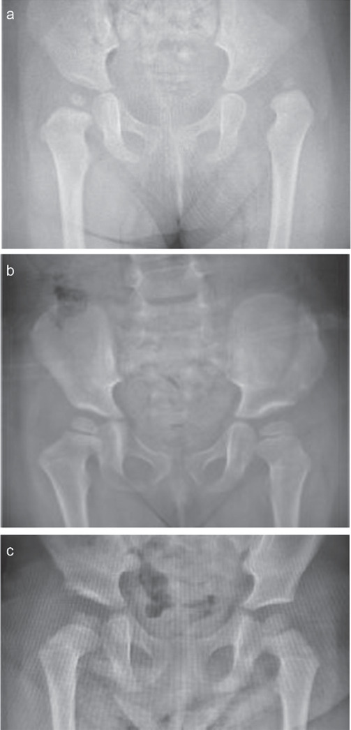 Clinical and radiological outcomes of Salter versus Pemberton osteotomies in the management of developmental dysplasia of the hip: A retrospective comparative study.