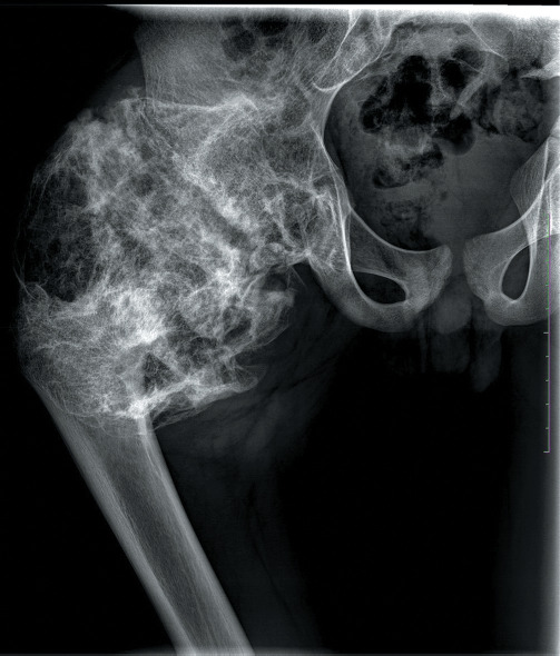 An unconventional presentation of Hip Joint Trevor disease with the involvement of the whole capital femoral epiphysis: A case report and literature review.