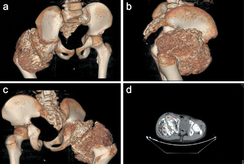 An unconventional presentation of Hip Joint Trevor disease with the involvement of the whole capital femoral epiphysis: A case report and literature review.