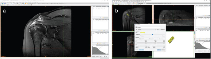 Serial magnetic resonance imaging evaluation of the early reaction of all-suture anchors in arthroscopic rotator cuff repair.