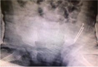 Clinical and radiological outcomes of Salter versus Pemberton osteotomies in the management of developmental dysplasia of the hip: A retrospective comparative study.