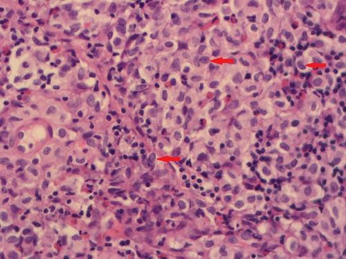 Langerhans cell histiocytosis presenting as a submucosal solitary colonic lesion: A case report and review of  the literature