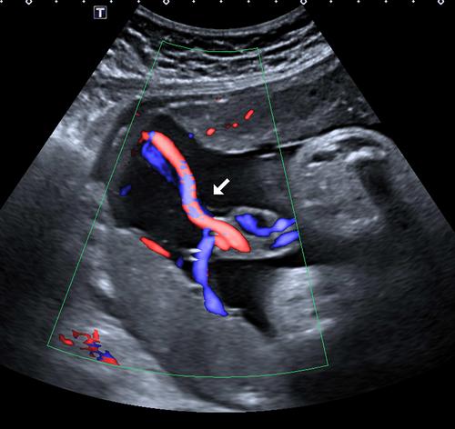 Furcate umbilical cord insertion with a bilobed placenta identified on prenatal ultrasonography