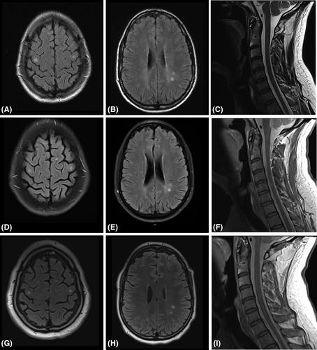 Familial cold autoinflammatory syndrome and multiple sclerosis