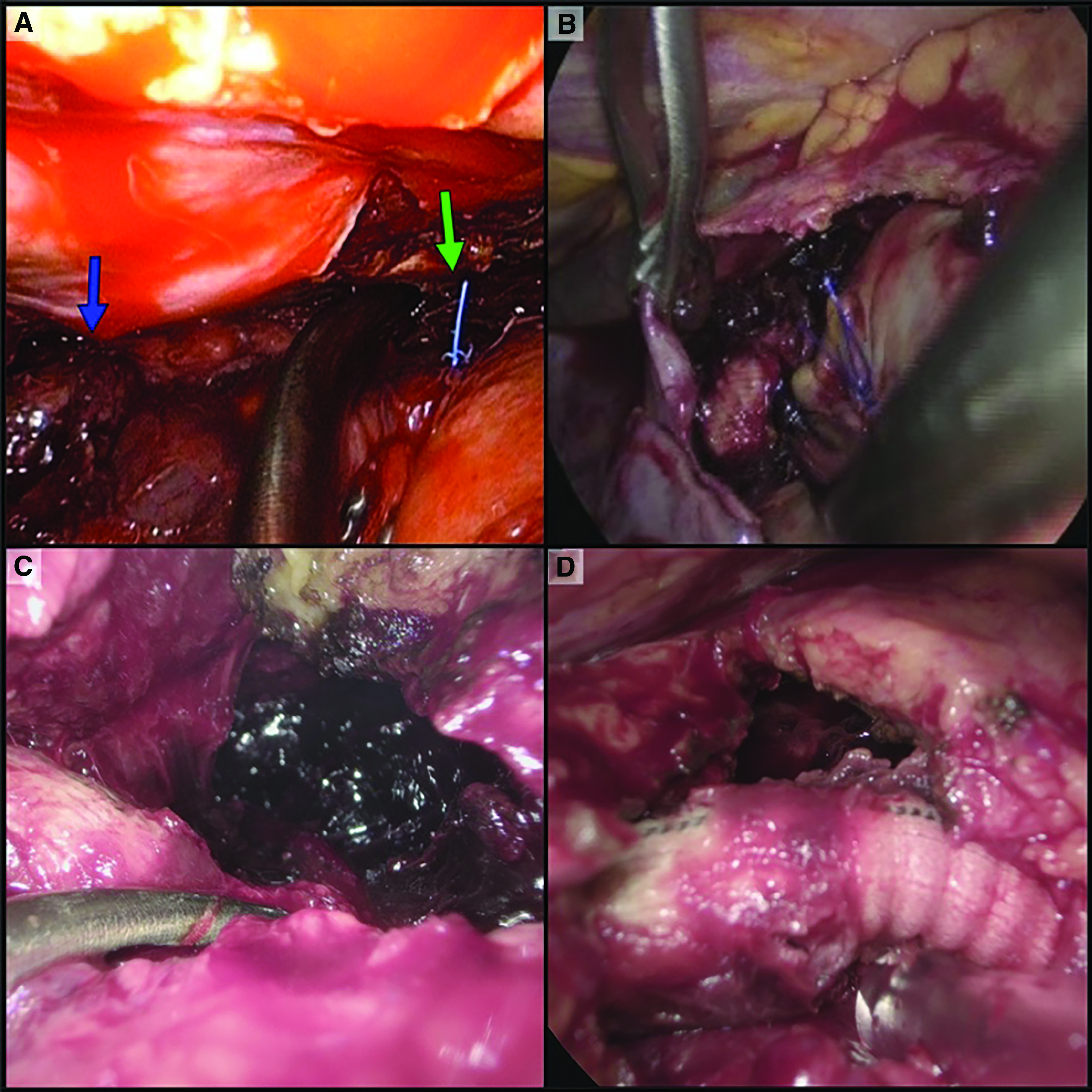 Video-Assisted Thoracoscopic Surgery Management of Subacute Retained Blood Syndrome after Cardiac Surgery.