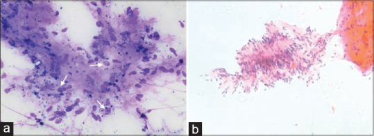 Schwannoma of Submandibular Gland: A Rare Salivary Gland Neoplasm Diagnosed by Fine Needle Aspiration.