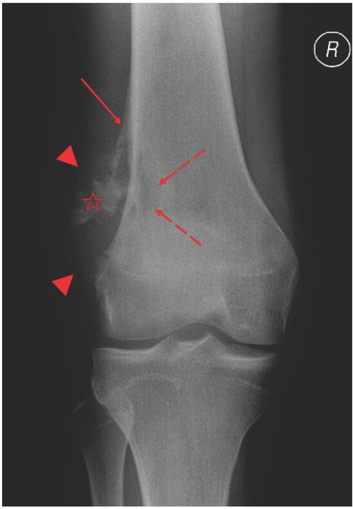 Suspicion of Recurrent Osteosarcoma in a Patient with Pseudotumour Adjacent To the Endoprosthesis.