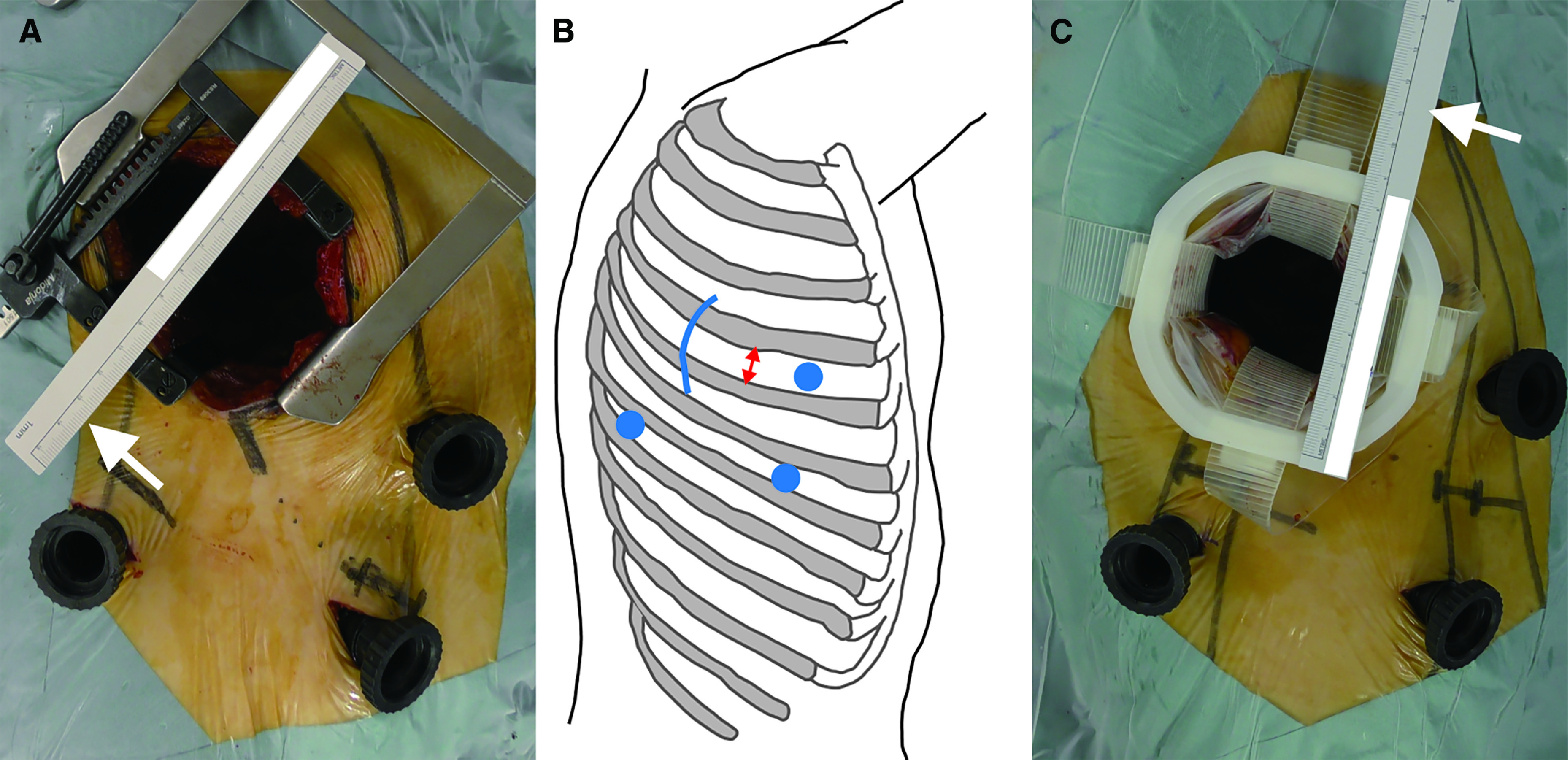 Comparison of Postoperative Quality of Life and Pain with and without a Metal Rib Spreader in Patients Undergoing Lobectomy through Axillary Mini-Thoracotomy for Stage I Lung Cancer.