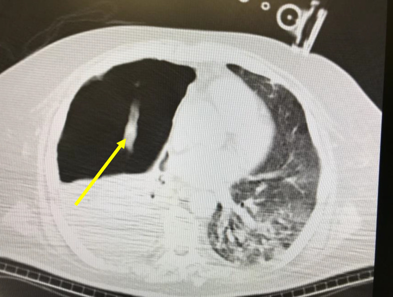 [Pulmonary cavitations, late complication of COVID-19].