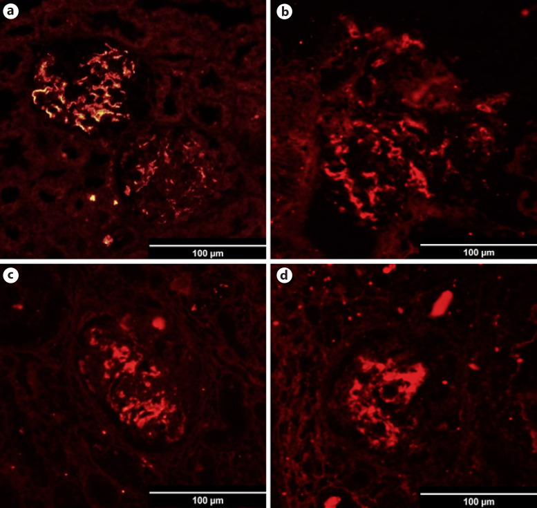 KM55 in the Evaluation of IgA-Containing Glomerular Diseases.